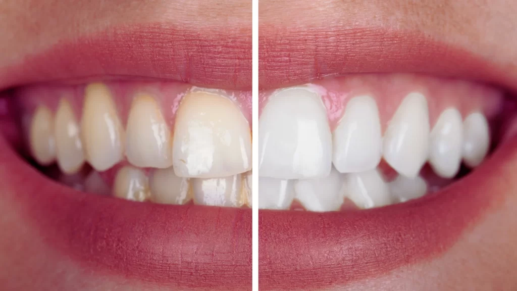 Teeth Whitening & Eye Correction